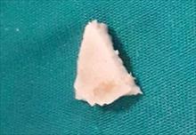 Mảnh xương to hình tam giác kẹt trong thanh quản bé 19 tháng tuổi